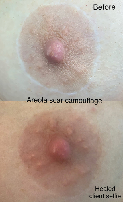 breast augmentation scar camouflage around areola before and after phoenix