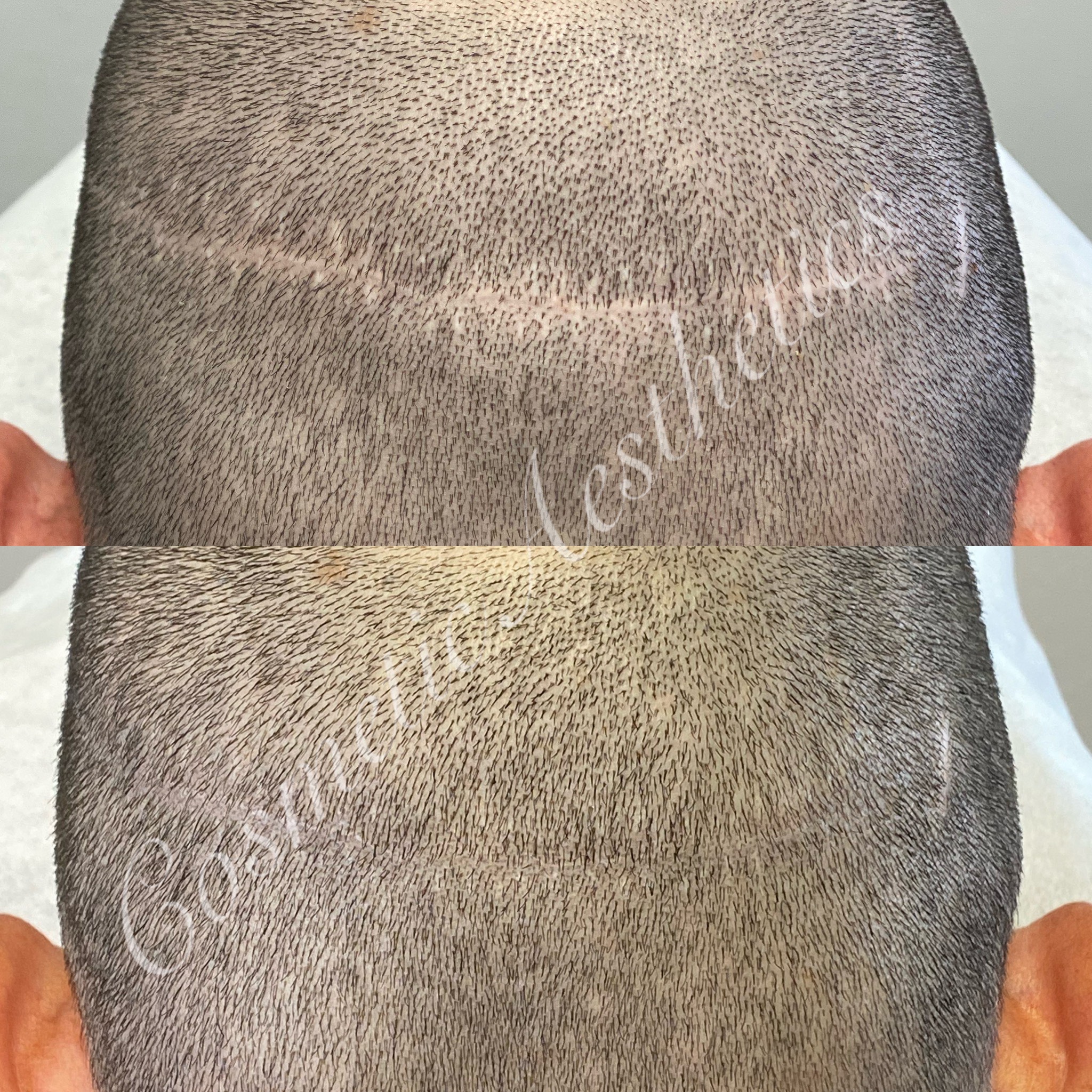 Scalp Micropigmentation Phoenix, AZ | SMP & Tricopigmentation