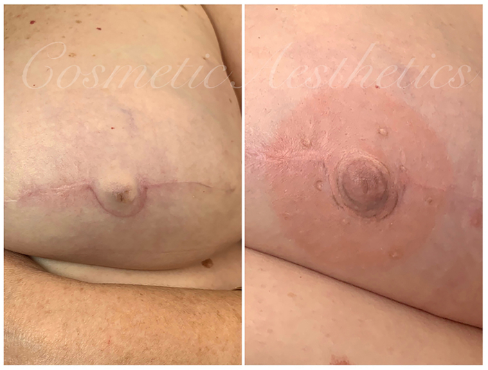 areola repigmentation after mastectomy reconstruction where nipple was spared