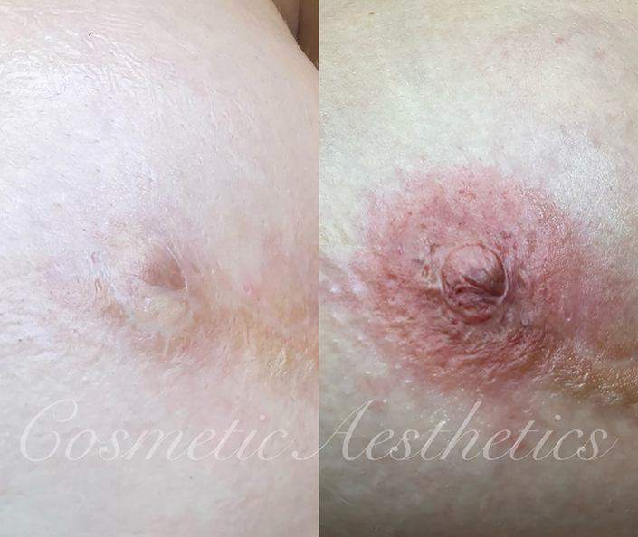 3d areola nipple tattoo after double mastectomy and breast reconstruction