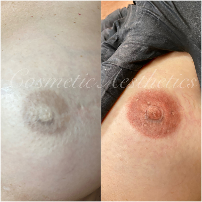 correction cover up tattoo of 3d areola on breast cancer survivor