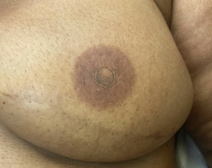 areola nipple tattoo after double mastectomy and breast reconstruction
