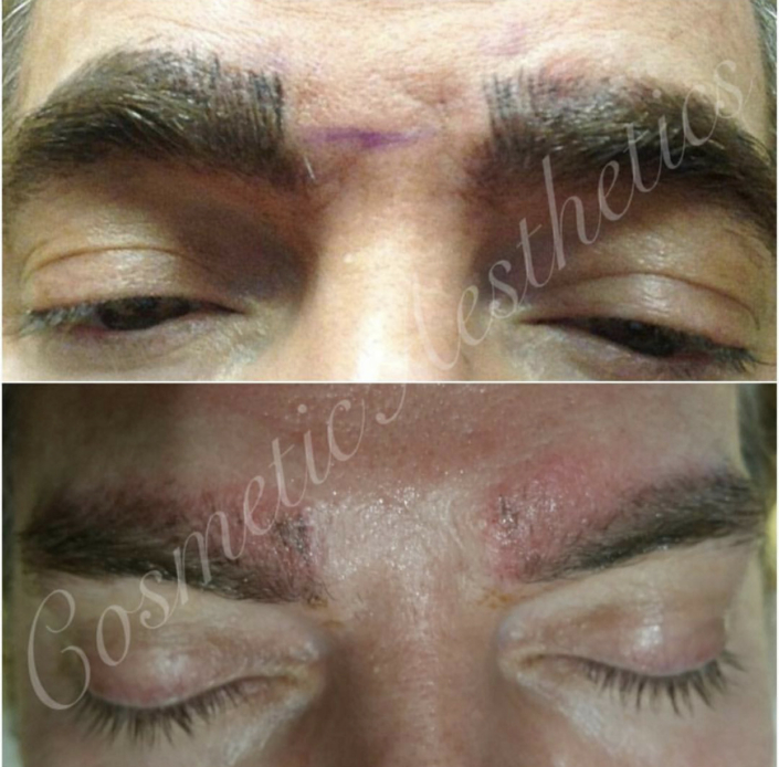 Emergency Tattoo Removal of Botched Microblading before and immediately after