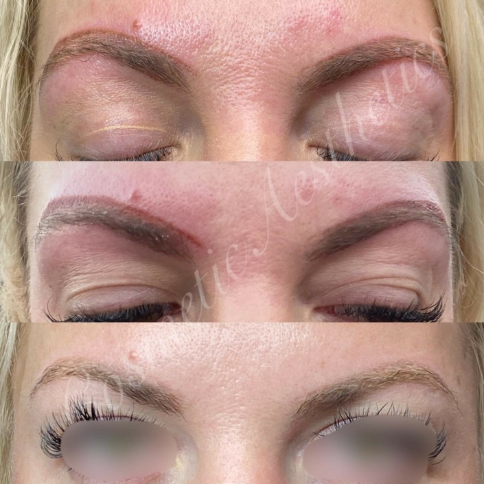 Emergency Tattoo Removal on Botched Eyebrows before, immediately after and healed results