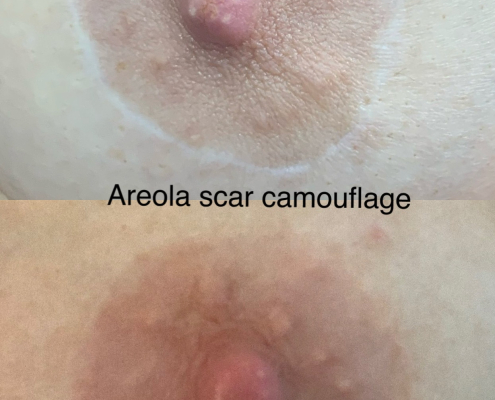 Breast Augmentation Areola Scar Camouflage