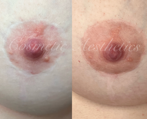 Breast Augmentation Areola Scar Camouflage Tattoo before and after healed results