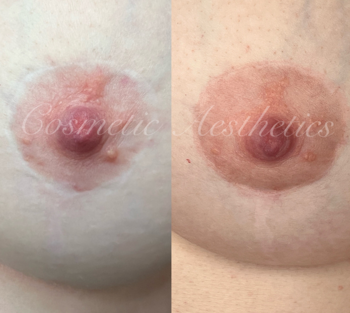 Breast Augmentation Areola Scar Camouflage Tattoo before and after healed results