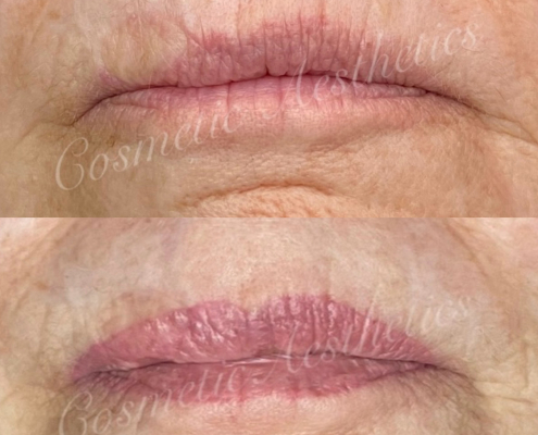 Skin Cancer Graft Scar Camouflage via Lip Blushing tattoo before and after healed results