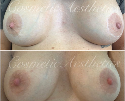 Breast Augmentation Areola Scar Camouflage