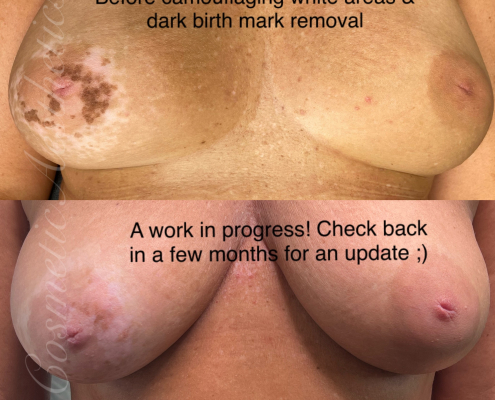 birth mark removal and areola scar camouflage before and after results