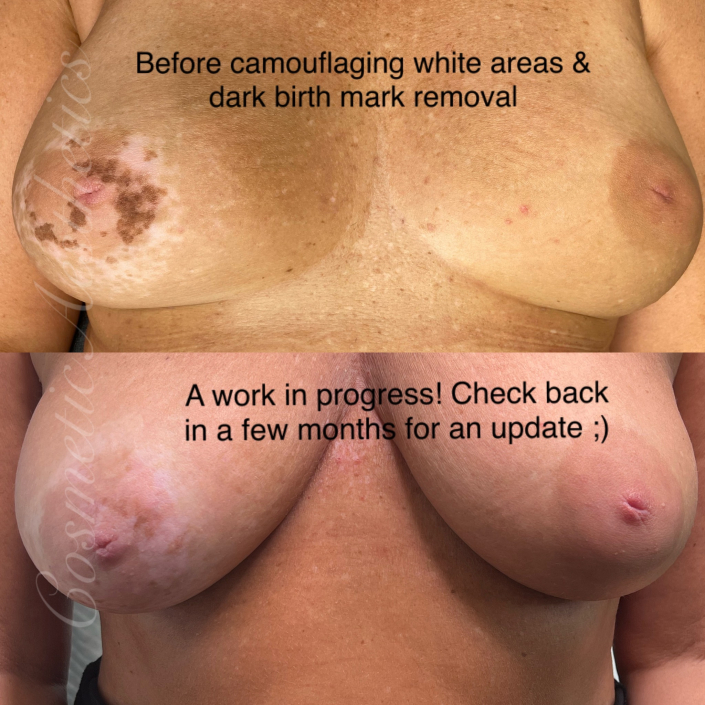 birth mark removal and areola scar camouflage before and after results
