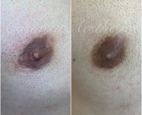 male breast cancer biopsy areola scar camouflage tattoo