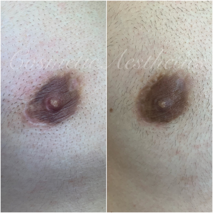 male areola scar camo