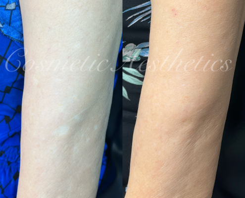 fair skin scar camouflage before and after healed results