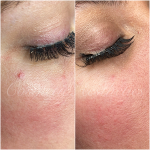 cherry angioma removal 2