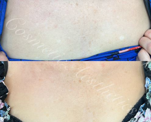 scar camouflage tattoo blending skin color ink fair skin