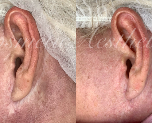 facelift scar camouflage fair skin