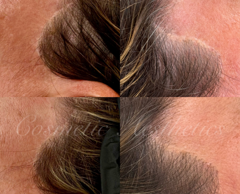 facelift scar camo before and after