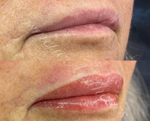 Skin Cancer Removal Scar Camouflage via Lip Blushing tattoo before and after healed results