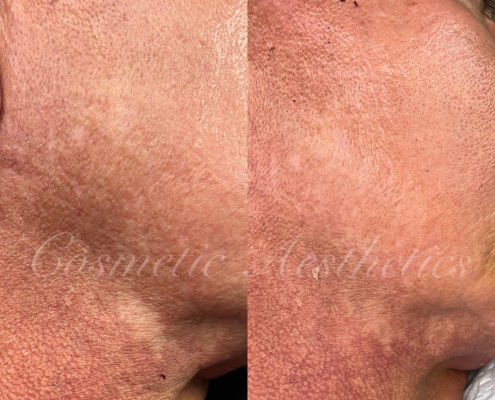 scar camouflage tattoo before and after healed results