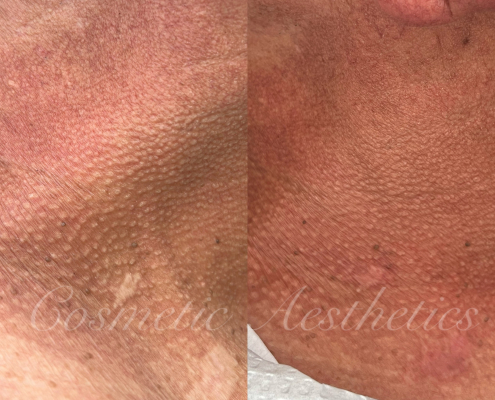 scar camouflage tattoo before and after healed results