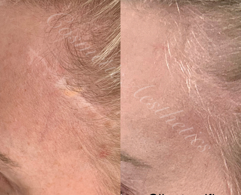 brow lift scar camouflage tattoo before and after results