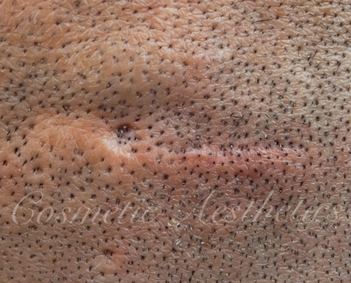 scalp scar camo smp scalp micropigmentation fut scar