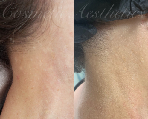 scar camouflage blending skin color