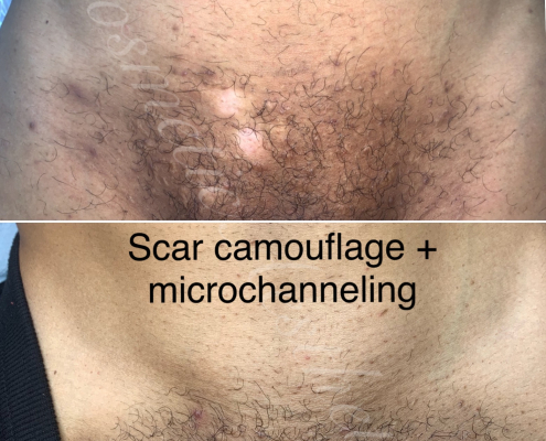 scar camouflage tattoo and microchanneling for scar rejuvenation and hair regrowth on ethnic skin