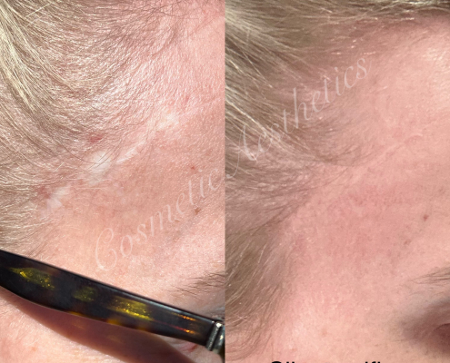 brow lift scar camouflage tattoo before and after healed results