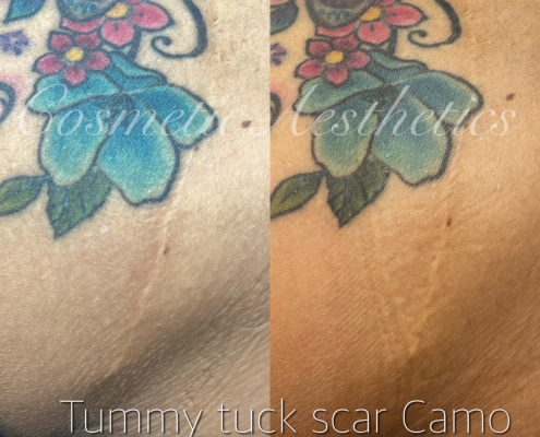 Tummy Tuck Scar Camouflage tattoo before and after results