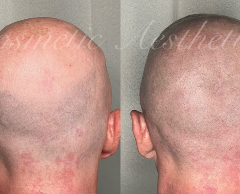 Scalp Micropigmentation Shaved Head Effect Hair Follicle Tattoo
