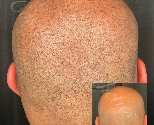 Scalp Micropigmentation Shaved Head Effect Hair Follicle Tattoo