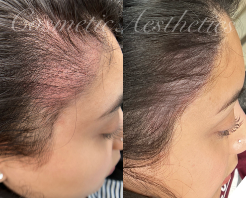 Female Scalp Micropigmentation Phoenix