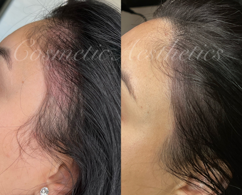 scalp micropigmentation Phoenix density tattoo for long hair