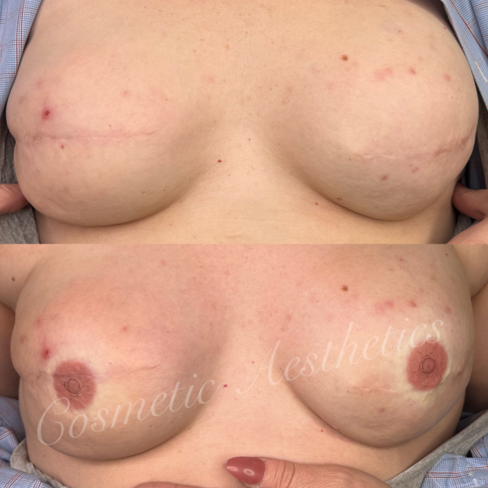 3d areola restoration tattoo Phoenix