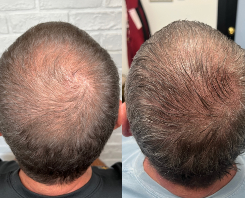 scalp micropigmentation density tattoo for long hair