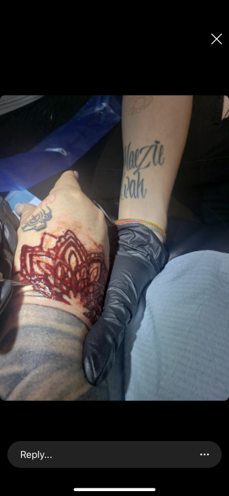 emergency removal hand tattoo