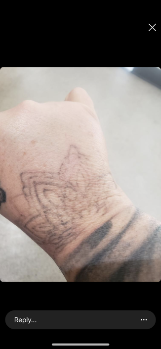 emergency removal hand tattoo healed