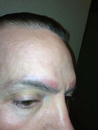 emergency removal healing process one week post procedure