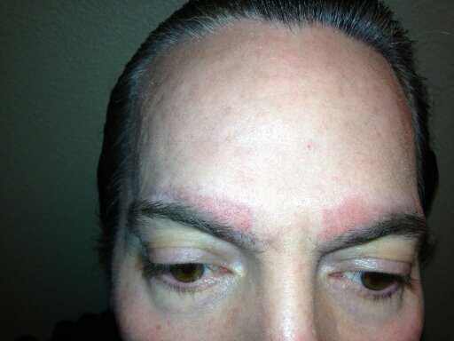 emergency removal healing process two weeks post procedure