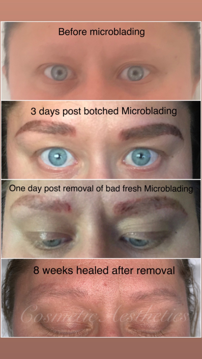 emergency removal of botched microblading before after and healed
