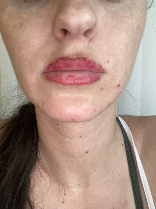 lip liner emergency removal healing process