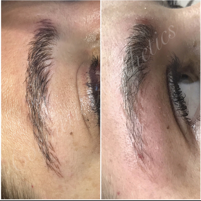 microblading removal before and immediately after