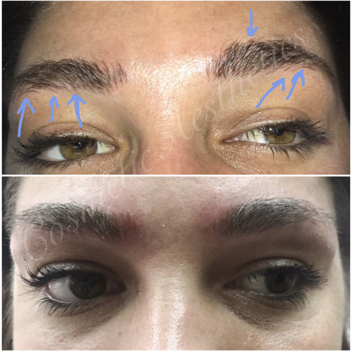 emergency removal on botched microblading before and immediately after