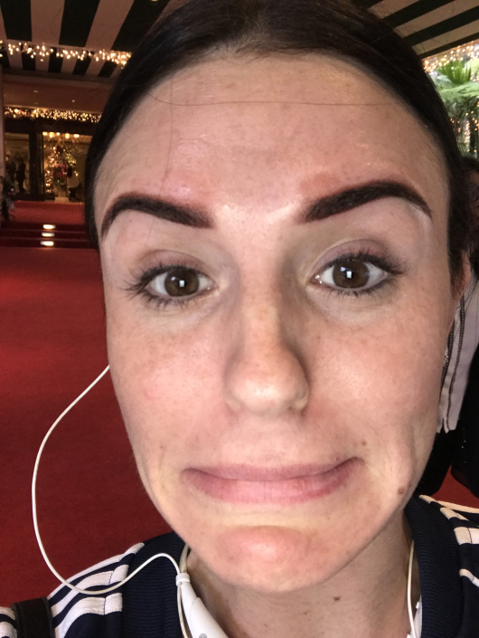 healing process of emergency removal of powder brow tattoo