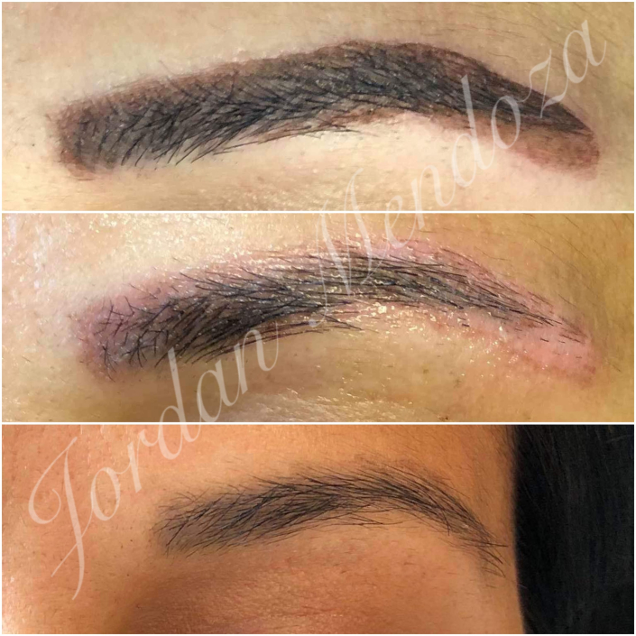 soft powder brow emergency removal before and after and healed results