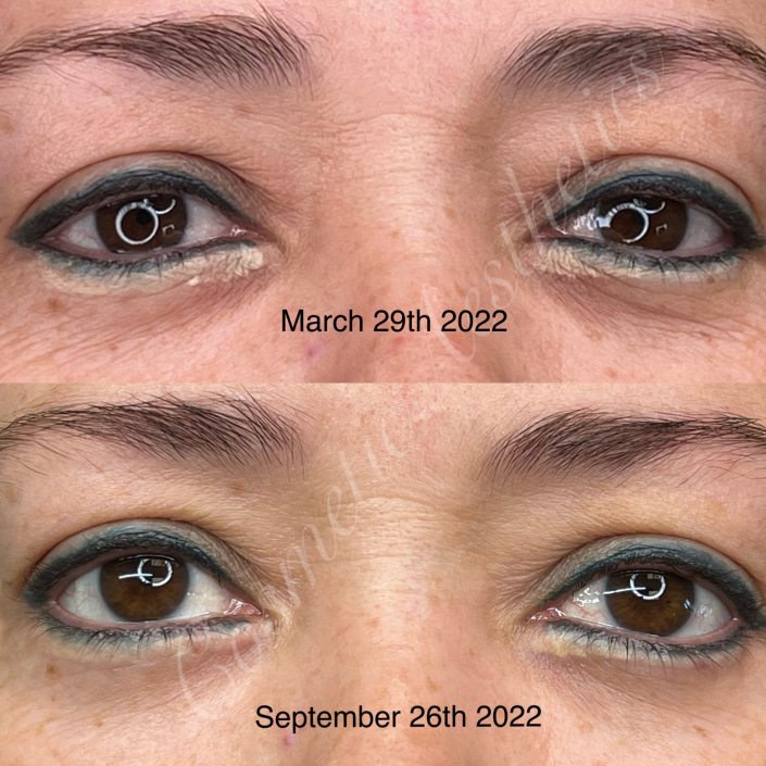 Xtract tattoo removal eyeliner before and after results