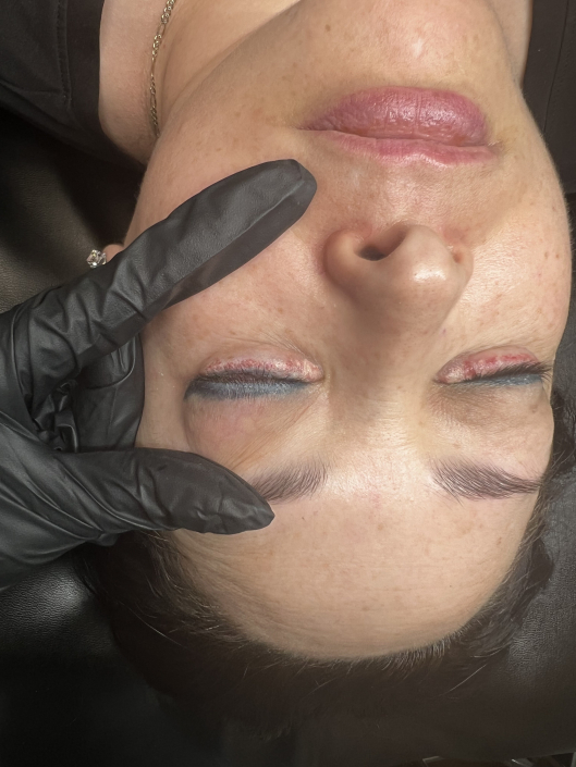 xtract eyeliner removal swelling immediately after procedure