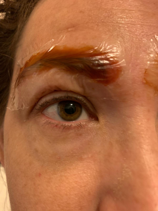 xtract tattoo removal eyebrows healing process